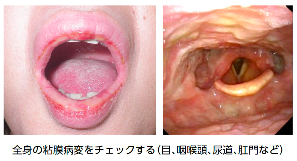  ICI による⽪膚障害：スティーブンス・ジョンソン症候群