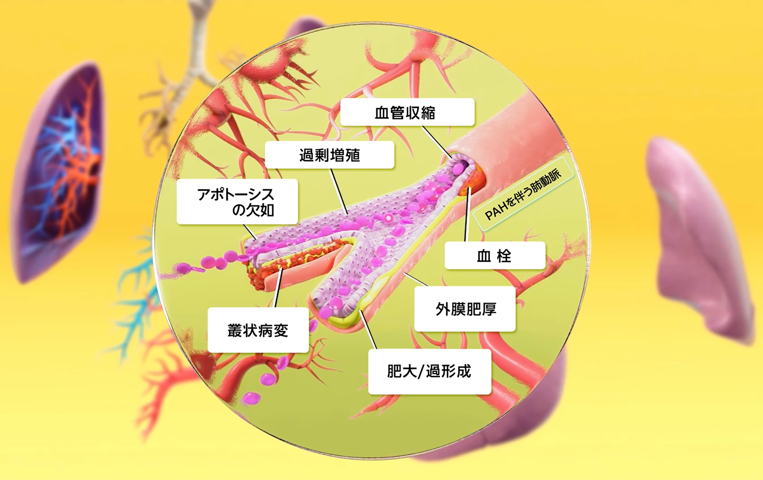 PAHの病態〜肺動脈のリモデリング～