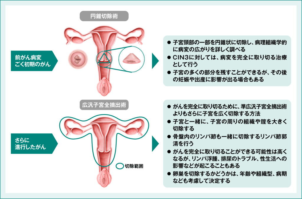 子宮頸がんの主な手術